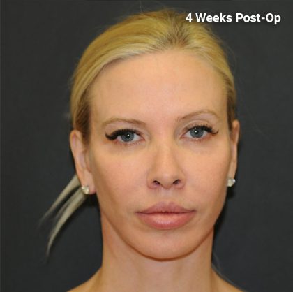 Facelift Before & After Patient #3025