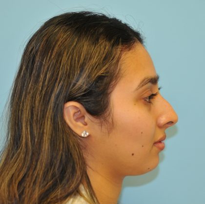Rhinoplasty Before & After Patient #3175