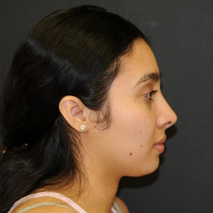Rhinoplasty Before & After Patient #3175