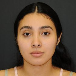 Rhinoplasty Before & After Patient #3175