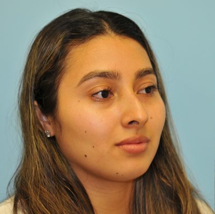Rhinoplasty Before & After Patient #3175
