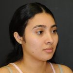 Rhinoplasty Before & After Patient #3175