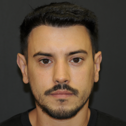 Rhinoplasty Before & After Patient #3168
