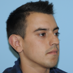 Rhinoplasty Before & After Patient #3168
