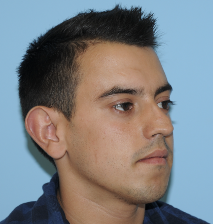 Rhinoplasty Before & After Patient #3168
