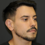 Rhinoplasty Before & After Patient #3168