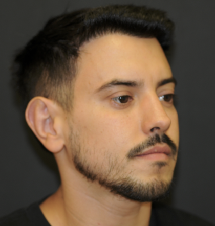 Rhinoplasty Before & After Patient #3168