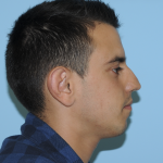 Rhinoplasty Before & After Patient #3168