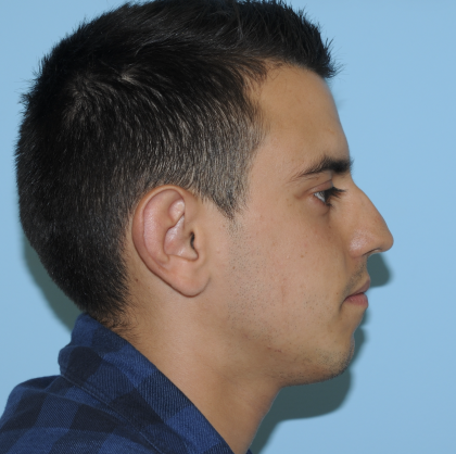 Rhinoplasty Before & After Patient #3168