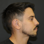 Rhinoplasty Before & After Patient #3168
