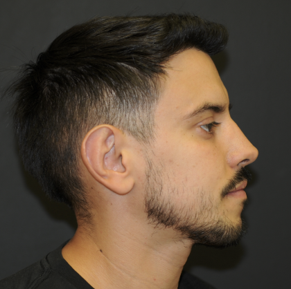Rhinoplasty Before & After Patient #3168