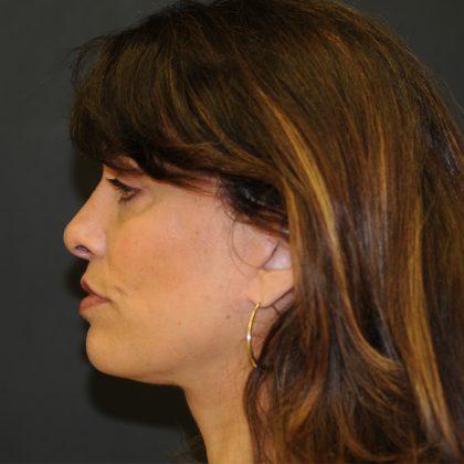 Brow Lift Before & After Patient #3198