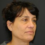 Brow Lift Before & After Patient #3198