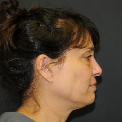 Brow Lift Before & After Patient #3198