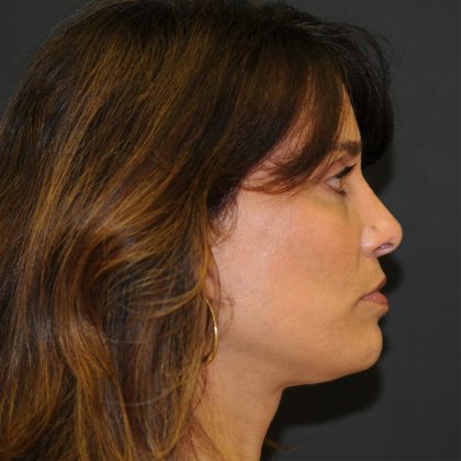 Brow Lift Before & After Patient #3198