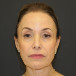 Blepharoplasty Before & After Patient #3219