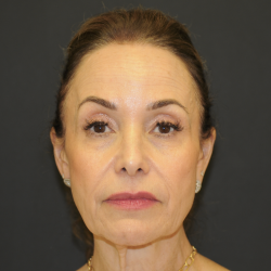 Blepharoplasty Before & After Patient #3219