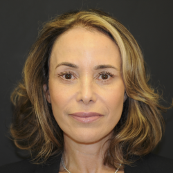 Blepharoplasty Before & After Patient #3219