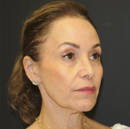 Blepharoplasty Before & After Patient #3219