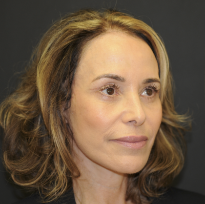 Blepharoplasty Before & After Patient #3219
