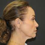 Blepharoplasty Before & After Patient #3219