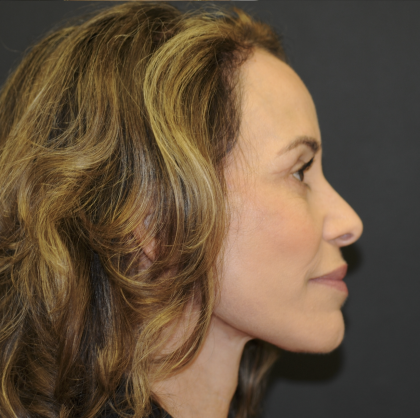Blepharoplasty Before & After Patient #3219