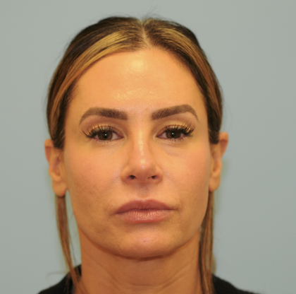 Facelift Before & After Patient #3247