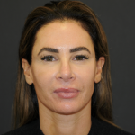 Facelift Before & After Patient #3247