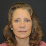 Brow Lift Before & After Patient #3233