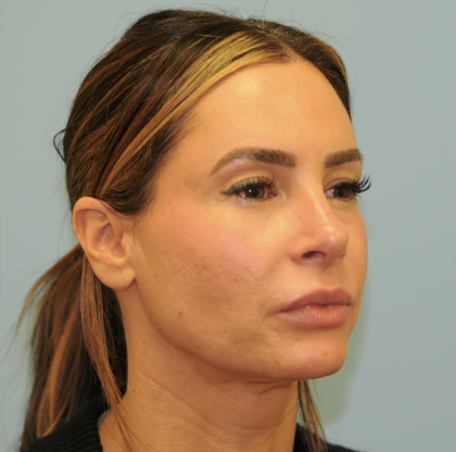Facelift Before & After Patient #3247