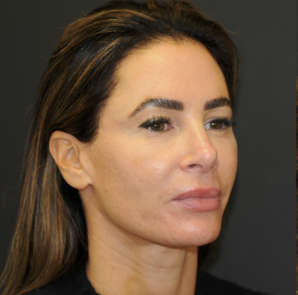 Facelift Before & After Patient #3247