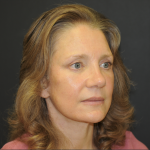 Brow Lift Before & After Patient #3233