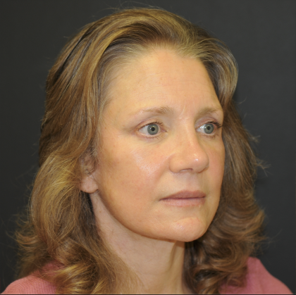 Brow Lift Before & After Patient #3233