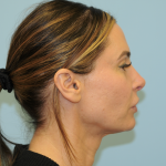 Facelift Before & After Patient #3247
