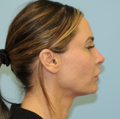Facelift Before & After Patient #3247