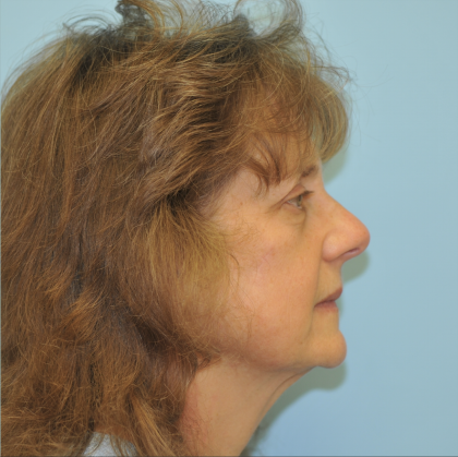 Brow Lift Before & After Patient #3233