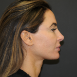 Facelift Before & After Patient #3247