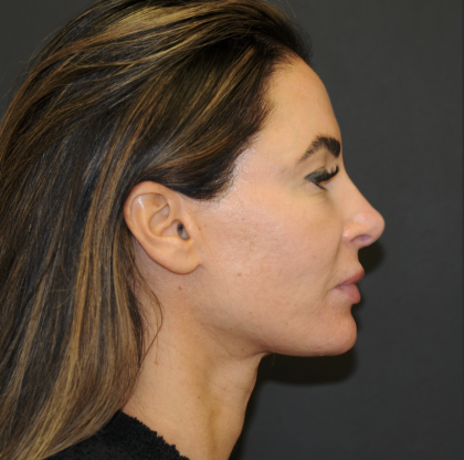 Facelift Before & After Patient #3247
