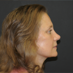 Brow Lift Before & After Patient #3233